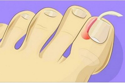 Zobacz jak w łatwy sposób poradzić sobie z wrastającymi paznokciami. Nie potrzebujesz pomocy lekarza