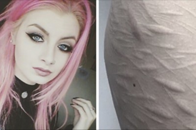 Żaden tatuażysta nie chciał zakryć blizn na ciele tej 19-latki. Poza tym jednym