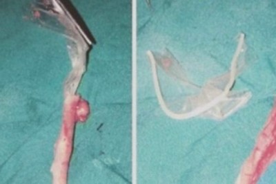 Strasznie bolał ją brzuch. Jak lekarze otworzyli jej jelito i zobaczyli powód, nie wierzyli własnym oczom