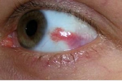 Oczy dają sygnał przed zawałem serca i udarem mózgu. Można z nich wyczytać, że stanie się coś złego 