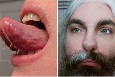 16 osób, których cechy genetyczne należą do najbardziej wyjątkowych na świecie