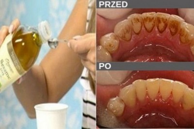 Zapomnij o nieświeżym oddechu, osadzie i bakteriach w ustach. Przy pomocy tylko jednego składnika dużo zmienisz