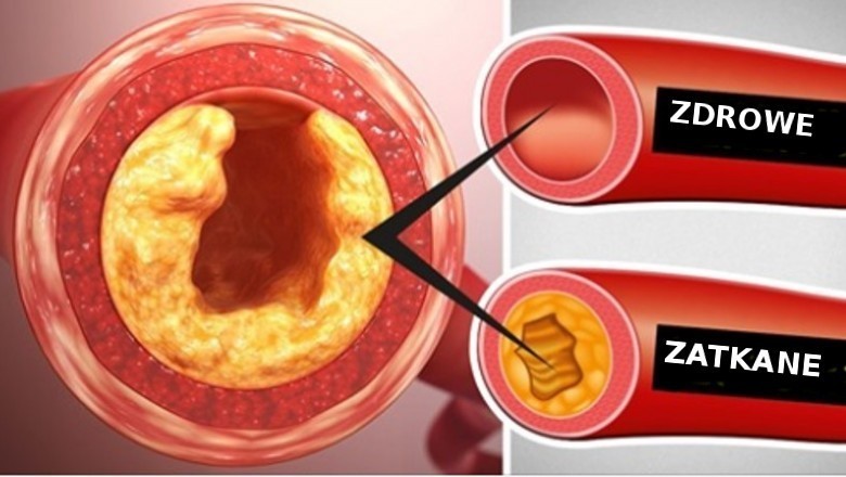 10 produktów spożywczych, których spożycie należy ograniczyć, żeby odetkać swoje żyły i arterie
