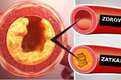 10 produktów spożywczych, których spożycie należy ograniczyć, żeby odetkać swoje żyły i arterie