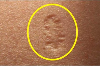 Z jakiego powodu po szczepieniu na ramieniu człowieka pojawia się ta mała blizna? Masz taką? 