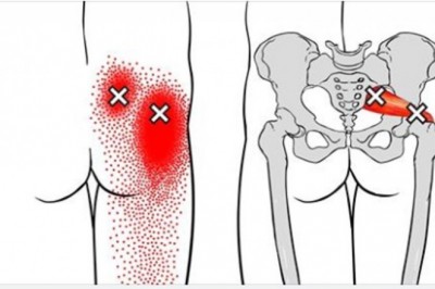 5 skutecznych sposobów na ból nerwu kulszowego. Mogą pomóc lepiej niż tabletki przeciwbólowe