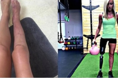 Przez 30 lat walczyła z bólem. W końcu kazała amputować swoją nogę 