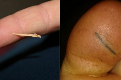 Mama musiała wyciągnąć drzazgę z palca córki. Pokazała jak zrobić to bezboleśnie