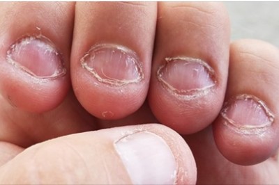 8 porad, które pomogą ci zerwać z nałogiem obgryzania paznokci