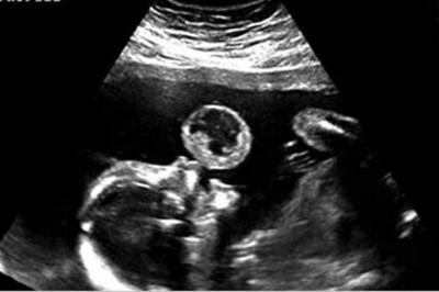 Sądziła, że na USG widać jak maluch puszcza bańki. Wtedy lekarz przekazuję jej złe nowiny