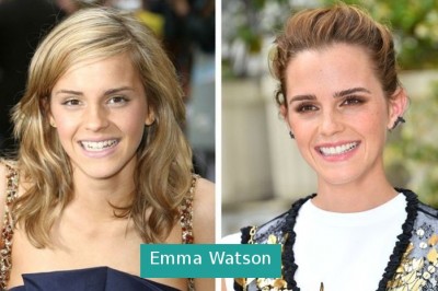 Zobacz jak zmieniły się uśmiechy 15 gwiazd po tym, jak naprawiły swoje uzębienie