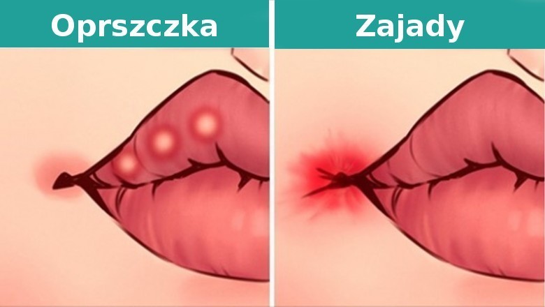 8 rzeczy, jakie stan twoich ust może powiedzieć o stanie twojego zdrowia