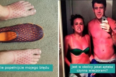 15 osób, które nigdy więcej nie zapomną o nałożeniu kremu przeciwsłonecznego