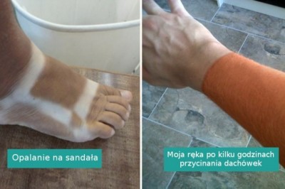 17 osób, które niechcący mocno przesadziły ze swoją opalenizną