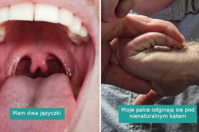 15 przypadków, w których natura postanowiła zagrać na loterii genetycznej