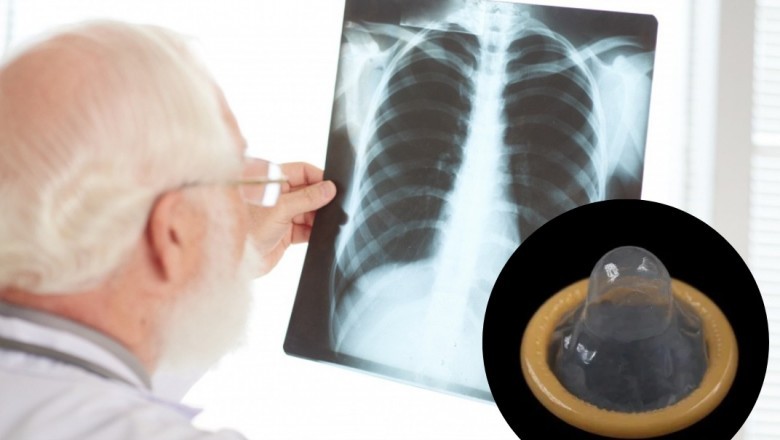 Przez 6 miesięcy zmagała się z kaszlem i gorączką. Lekarze odkryli nietypowe ciało obce w drogach oddechowych